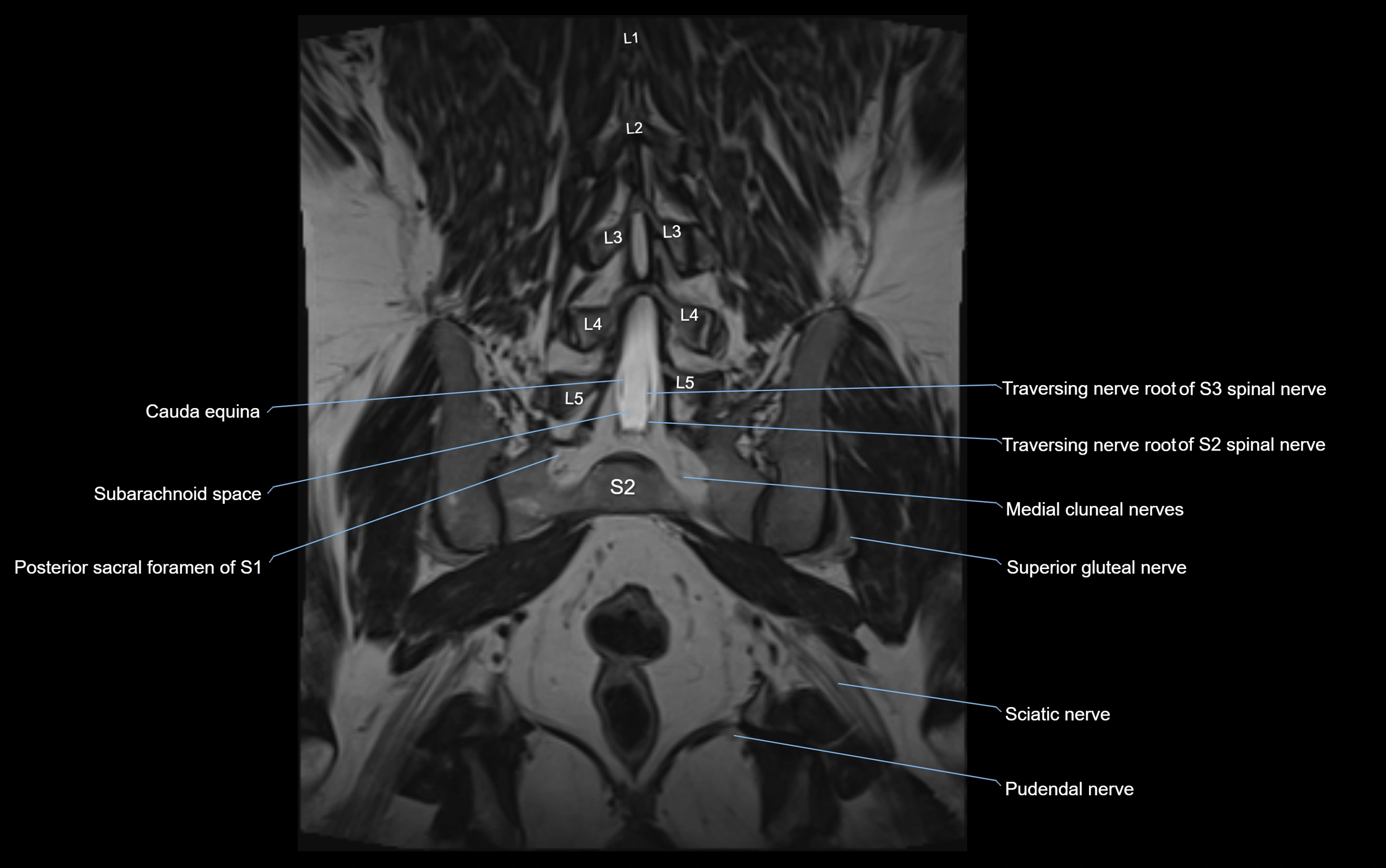 MR lumbosacral plexus cross sectional anatomy 3T  radiology  image-img-09001-00052.webp